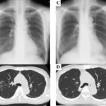 Mycobacterium Avium Complex