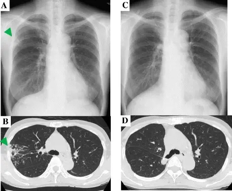 Mycobacterium Avium Complex