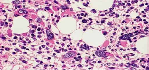 Myelodysplastic Syndromes