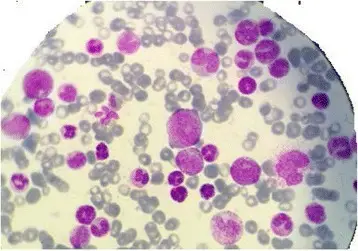 Myeloproliferative Disorders