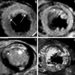 Myocardial Infarction