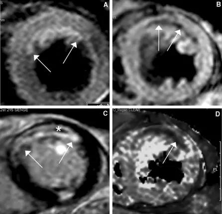 Myocardial Infarction