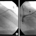 Myocardial Vessel Vasospasm