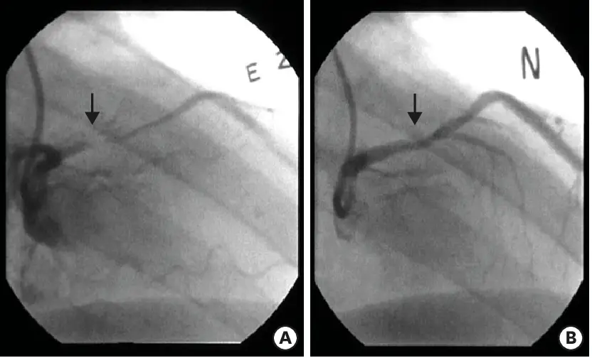 Myocardial Vessel Vasospasm