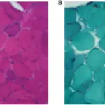 Myoclonic Epilepsy and Ragged Red Fibers (MERRF)