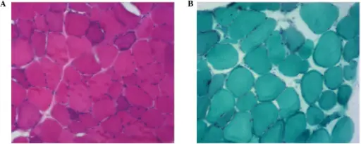 Myoclonic Epilepsy and Ragged Red Fibers (MERRF)