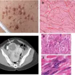 Myofibroma