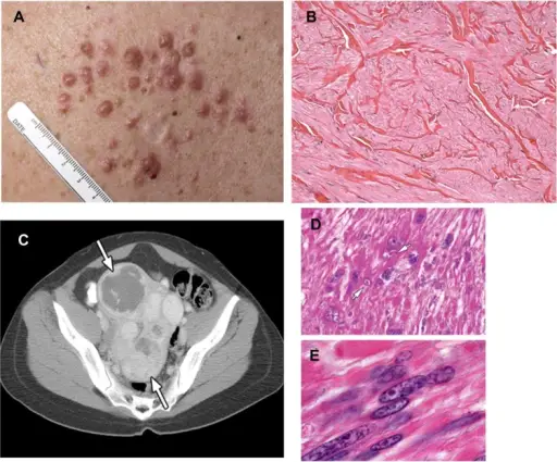 Myofibroma