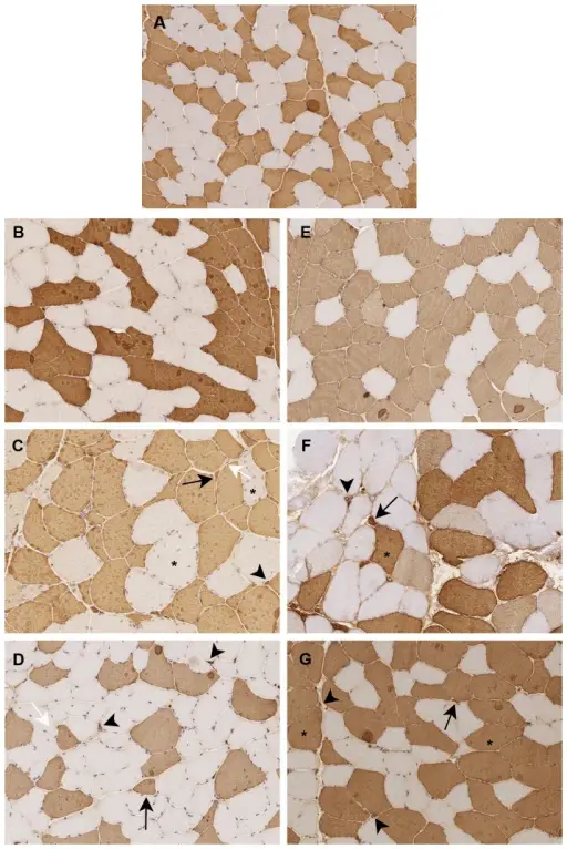 Myotonic Dystrophy