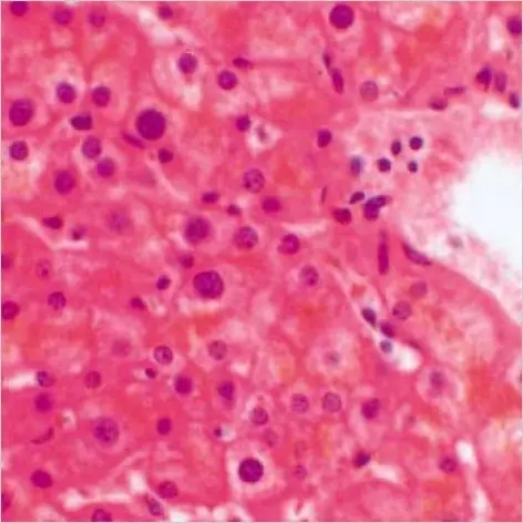 Myxedema