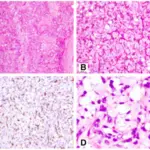 Myxoid Liposarcoma