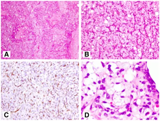 Myxoid Liposarcoma