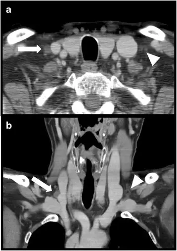 NECK PATHOLOGY