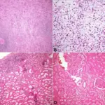 NONSPECIFIC ACUTE SPLENITIS