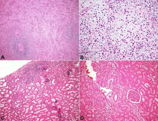 NONSPECIFIC ACUTE SPLENITIS