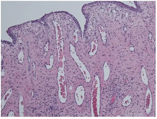 Nasopharyngeal Angiofibroma