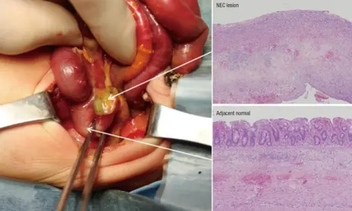 Necrotizing Enterocolitis