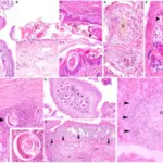 Necrotizing Lesions of the Nose and Upper Airways