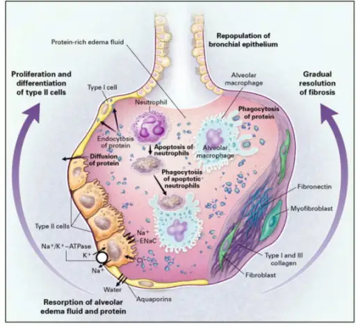 Neonatal Respiratory Distress Syndrome