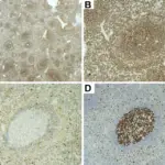 Neoplasms of Spleen