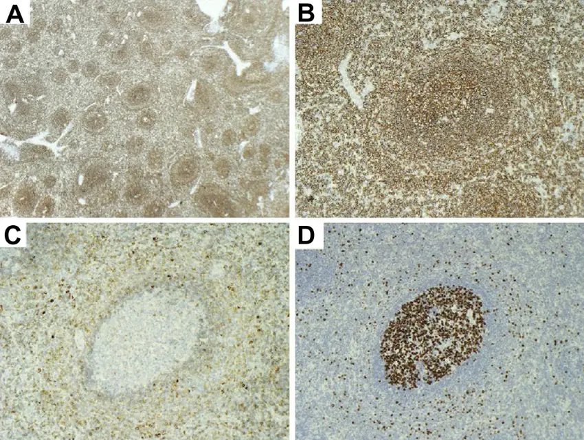 Neoplasms of Spleen