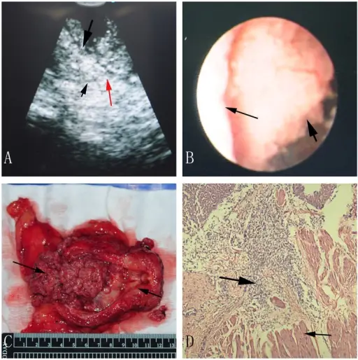 Neoplasms of the Bladder