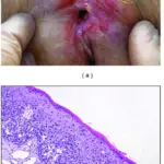 Neoplastic Glandular Lesions of the Vulva