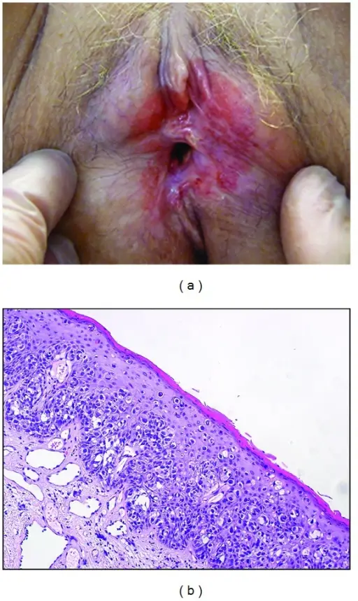 Neoplastic Glandular Lesions of the Vulva