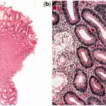 Neoplastic Polyps