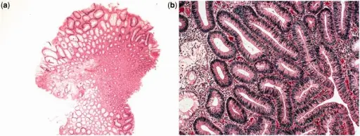 Neoplastic Polyps