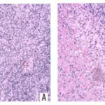 Neoplastic Proliferations of White Cells