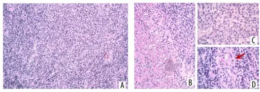 Neoplastic Proliferations of White Cells