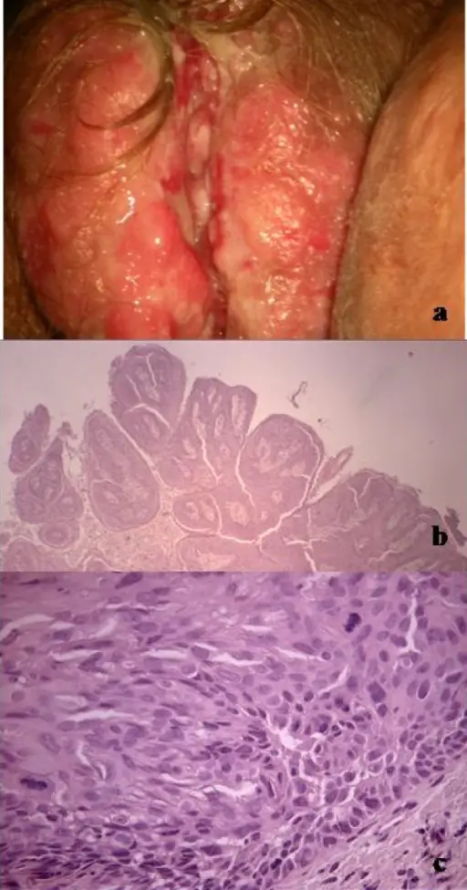 Neoplastic Squamous Lesions of the Vulva