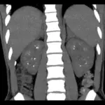 Nephrocalcinosis