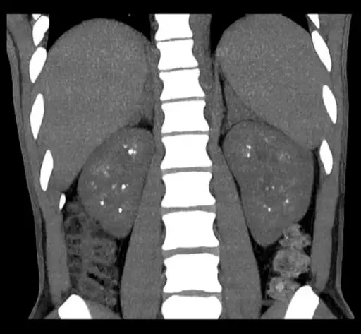 Nephrocalcinosis