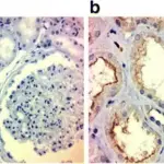 Nephrosclerosis