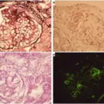 Nephrotic Syndromes