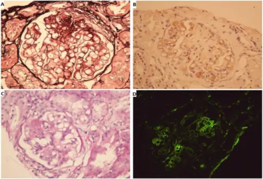 Nephrotic Syndromes