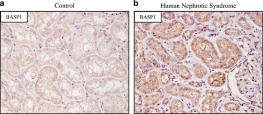 Nephrotic Syndromes