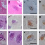 Neurodegenerative Diseases