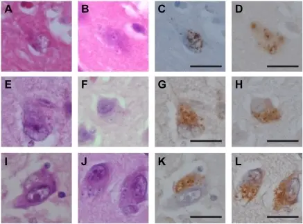 Neurodegenerative Diseases