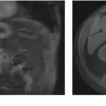 Neuroendocrine Tumor of the Gallbladder