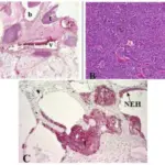 Neuroendocrine Tumors of the Lung