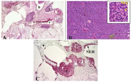 Neuroendocrine Tumors of the Lung