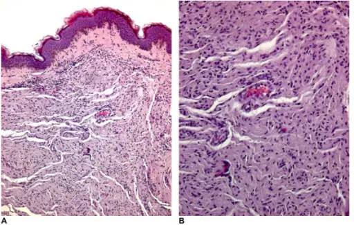 Neurofibroma