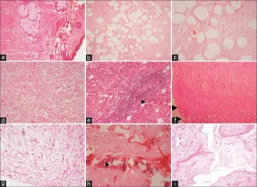 Neurofibromas