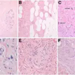 Neurofibromatosis