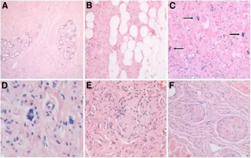 Neurofibromatosis