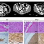 Neurofibromatosis Type 1