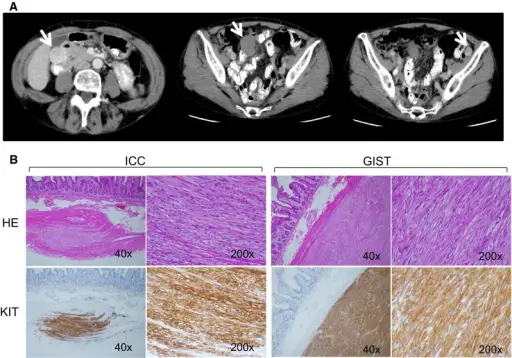 Neurofibromatosis Type 1